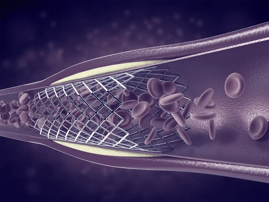 Ortese Med - BG - Cirurgia Vascular - Slide